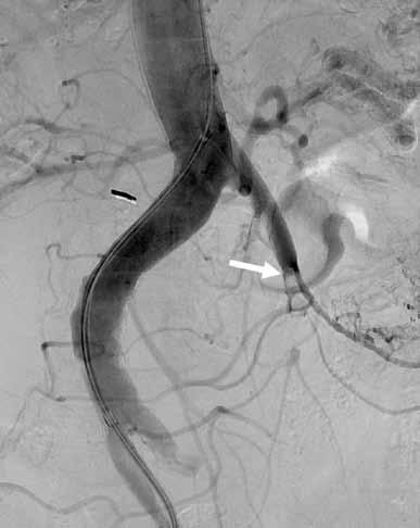 A) Laajat ateroskleroosimuutokset (valkoiset alueet aortan seinämässä) akuutin vatsakivun vuoksi tehdyssä tietokonetomografiassa.