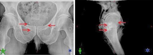 KATSAUS A B Kuva 7. Kuvantamisohjauksinen sädehoito. A) Röntgenkuva edestä. B) Röntgenkuva sivulta. Eturauhaseen implantoidut kultamerkit näkyvät erinomaisesti päivittäisissä kuvauksissa.