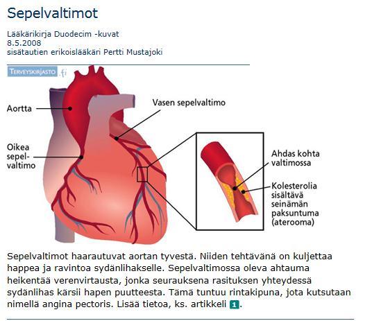 Sepelvaltimotauti Jos sepelvaltimoiden seinät ovat ateroskleroottiset, niiden joustavuus vähenee ja halkaisija pienenee sydämen verensaannista huolehtiminen vaikeutuu Pääoireena angina pectoris