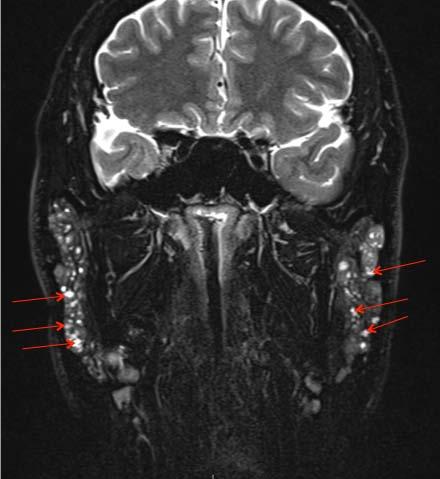 19 Risselada AP, Kruize AA, Bijlsma JW. Clinical features distinguishing lymphoma development in primary Sjögren s syndrome a retrospective cohort study. Semin Arthritis Rheum 2013;43:171 7.