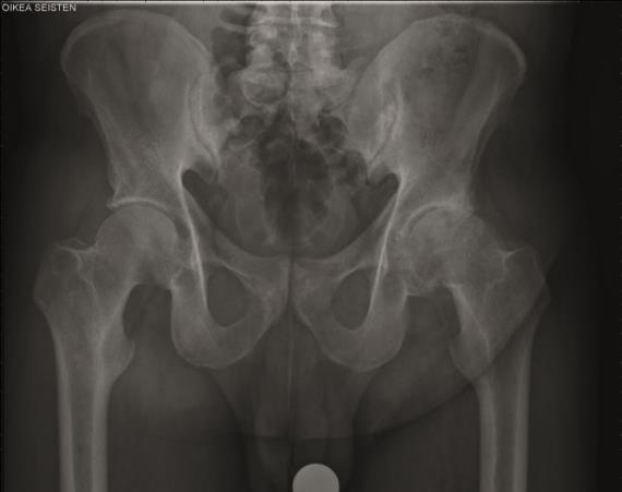 Kuvassa näkyy vasemman lonkan nivelrikko. Leikkauksen jälkeinen röntgenkuva, jossa näkyy uusi lonkan tekonivel.
