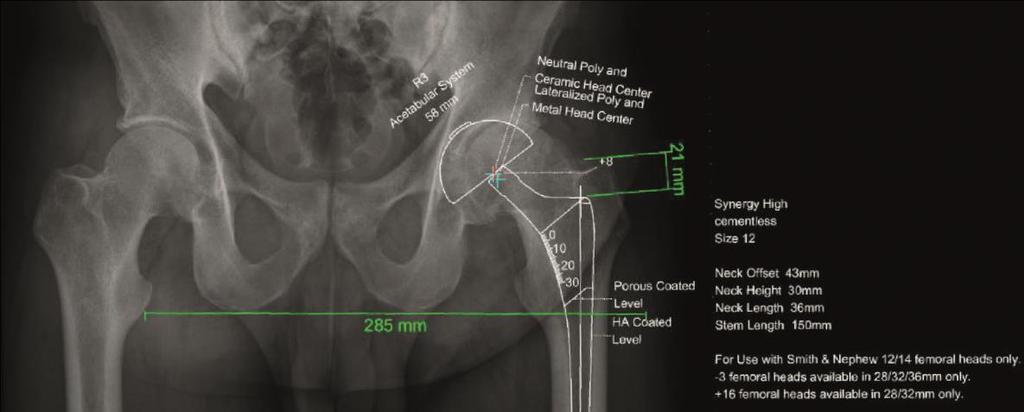 Röntgenkuvassa näkyy tietokoneohjelmalla tehty lonkan