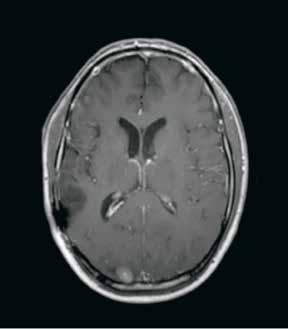 A B KUVA. Esimerkki aivolymfooman kasvunopeudesta. Saman potilaan pään magneettikuva kolmen viikon välein. oli sama, PRECIS-tutkimuksessa kantasolujensiirrolla saavutettiin parempi etenemättömyysaika.