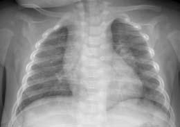 TAPAUSSELOSTUS A B la sijainneet pneumoniset muutokset olivat ohentuneet mutta eivät hävinneet.