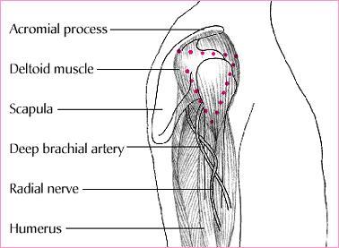 7 Hartialihas (kuviossa 2 deltoid muscle) sijaitsee käsivarren yläosassa. Se paikannetaan tasasivuisen kolmion muotoiselle alueelle olkalisäkkeestä 2-3 sormenleveyden verran alaspäin.