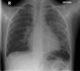 Thoraxkuvassa nähdään oikealla ylä- ja alalohkossa sekä vasemmalla alalohkossa tiiviit pneumoniakonsolidaatit.