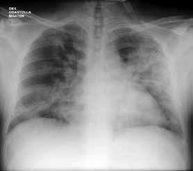 Sairaalaan tullessa hengitys oli vaikeutunutta ja happikyllästeisyys huoneilmalla oli 91 %. Keuhkokuvassa todetaan vasemmal- 2404 tetut influenssa A(H1N1)v-tapaukset viime vuoden epidemian ajalta.