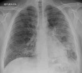 Potilas lähetettiin sairaalahoitoon. Tulovaiheessa keuhkoissa todetaan molemminpuoliset laaja-alaiset varjostumat (F).