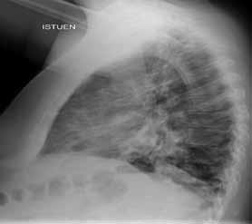 Nenänielun A(H1N1)v-näyte pysyi positiivisena koko hoitojakson ajan. H L) 27-vuotiaalla lievää astmaa sairastavalla miehellä oli esiintynyt kuumetta ja yskää noin viisi vuorokautta.