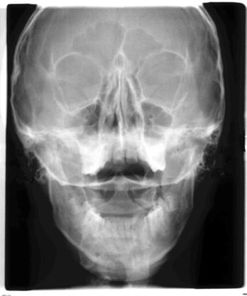 5 Käyttö Sirona Dental Systems GmbH 5.1 Röntgenkuvaus Käyttöohje ORTHOPHOS SL 2D / 3D 5.1.2.5 Kaukoröntgenkuvaus 5.1.2.5.1 Ohjelmakuvaus Ota huomioon eri katselusuunta lääketieteellisessä ja hammaslääketieteellisessä radiologiassa.
