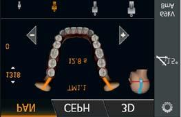 5 Käyttö Sirona Dental Systems GmbH 5.1 Röntgenkuvaus Käyttöohje ORTHOPHOS SL 2D / 3D Kaksiosainen leukanivelen kuvausohjelma TM 1.1 Kaksiosaisessa kuvausohjelmassa TM 1.1 otetaan kaksi kuvaa (TM 1.