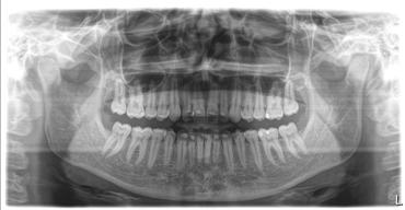 5 Käyttö Sirona Dental Systems GmbH 5.1 Röntgenkuvaus Käyttöohje ORTHOPHOS SL 2D / 3D 5.1.2 Kuvausohjelman valinta 5.