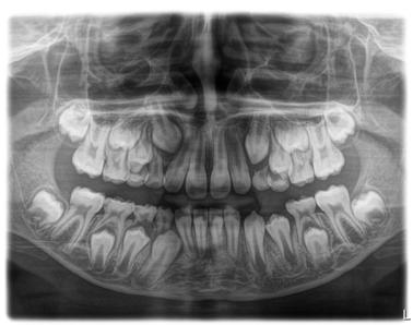 Sirona Dental Systems GmbH Käyttöohje ORTHOPHOS SL 2D / 3D 5 Käyttö 5.1 Röntgenkuvaus 5.1.2.1.1.2 P2 panoraamakuvaus, ilman alaleukaluun kaarta Kuva edustaa rajattua hammasaluetta ilman alaleukaluun kaarta.