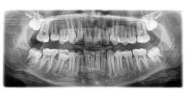 5 Käyttö Sirona Dental Systems GmbH 5.1 Röntgenkuvaus Käyttöohje ORTHOPHOS SL 2D / 3D 5.1.2.1.1.3 P10 Panoraamakuvaus lapsille Kuva edustaa rajattua hammasaluetta ilman alaleukaluun kaarta.