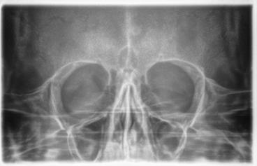 5 Käyttö Sirona Dental Systems GmbH 5.1 Röntgenkuvaus Käyttöohje ORTHOPHOS SL 2D / 3D 5.1.2.3 Sinuskuvaus 5.
