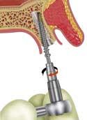 Immediate Provisional Implant Kliiniset toimenpiteet & tuoteluettelo Toimenpide Epäsuora toimenpide Osittain tai täysin hampaattomat potilaat Suorita vaiheet 1 7. Vaihe 8. Aseta suojat implantteihin.