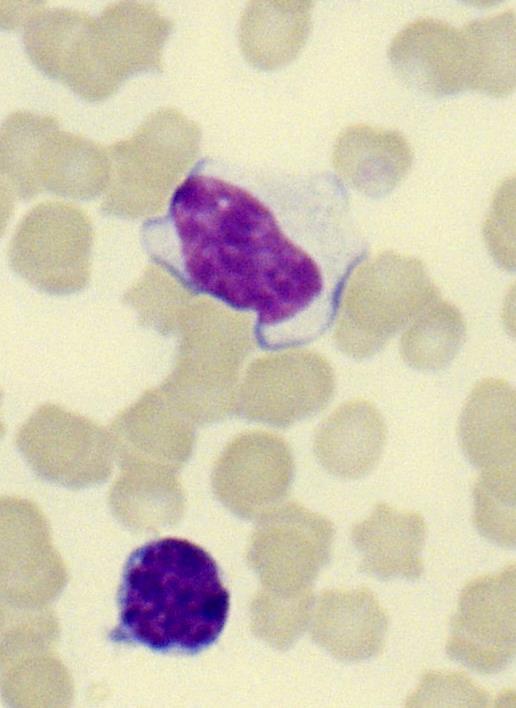 15 vosten verenkuvassa, mutta sen sijaan suuret granulaiset lymfosyytit (LGL, large granular lymphocytes) ovat tavallisia.