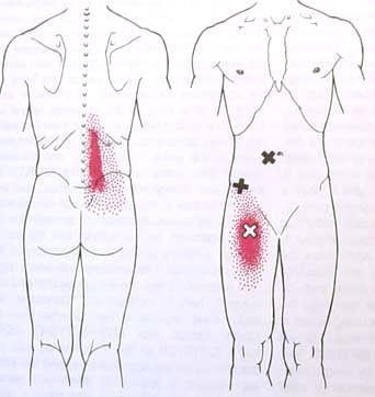 Triggerpisteen itsehoito, selkälihakset ja lonkankoukistaja Triggerpisteet ovat lihaksessa tai lihaskalvossa olevia ärsyyntyneitä alueita.