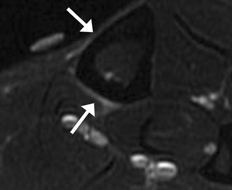 Kuvantamislöydöksiä - MRI T2,