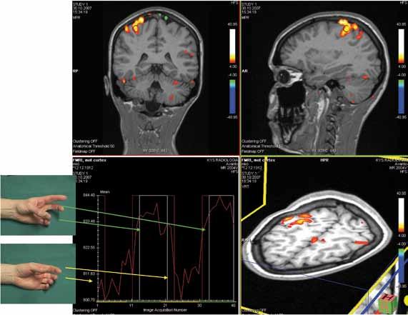 EPILEPSIA don suunnittelussa käytetään myös toiminnallista magneettikuvausta erityisesti motoristen alueiden paikantamisessa ja tulevaisuudessa todennäköisesti yhä enemmän myös puheen lateralisaation
