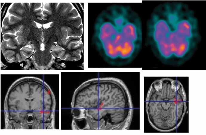 EPILEPSIA A B C D Kuva 4. Potilas lähetettiin magneettikuvaukseen monimuotoisten paikallisalkuisten kohtausten vuoksi. Magneettikuvauksessa (A) löydöksenä oli molemminpuolinen hippokampusskleroosi.