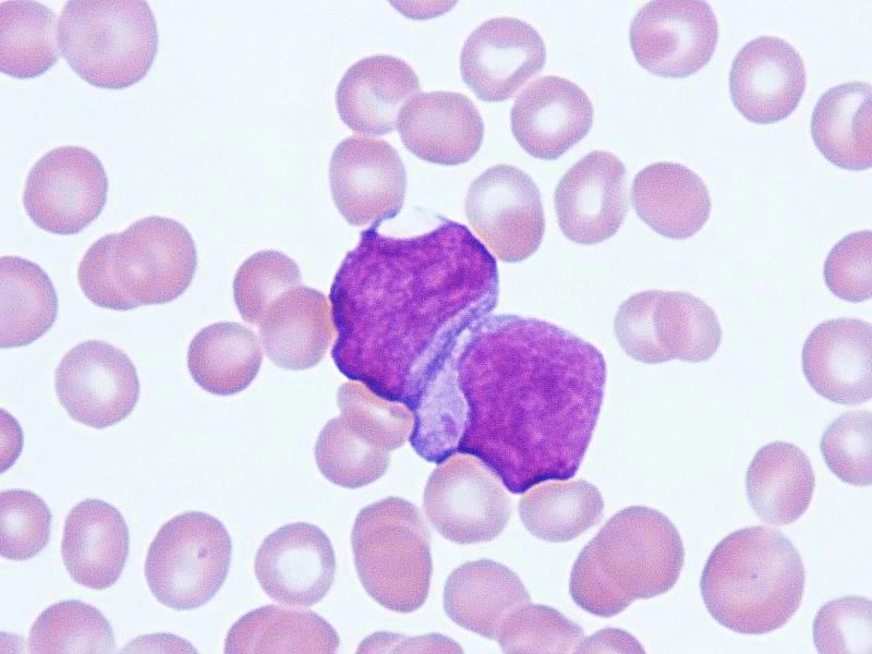 16 normaali hematopoieesi väistyy. Silloin vereen ilmaantuu suuria määriä blastisoluja ja kehittyy anemia. Myös granulosyyttien ja trombosyyttien määrä veressä laskee.