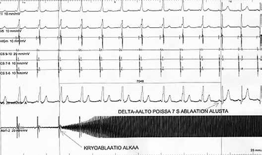 KUVA 2. Sydämen sisäiset signaalit kryoablaation aikana. Kun oikorata katkeaa, delta-aalto häviää ja sinusrytmi jatkuu ilman todettavaa häiriötä normaalissa eteis-kammiojohtumisessa.