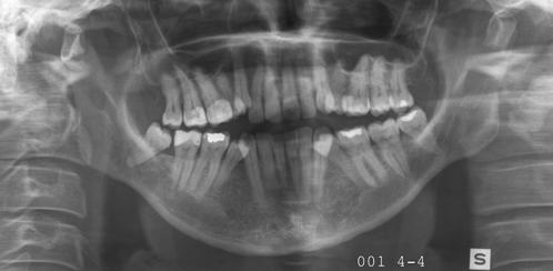 !! Alaleuan angulus ja korpusmurtumat (foramen mandibulaen ja foramen mentaliksen väliset) - sensoriikka!