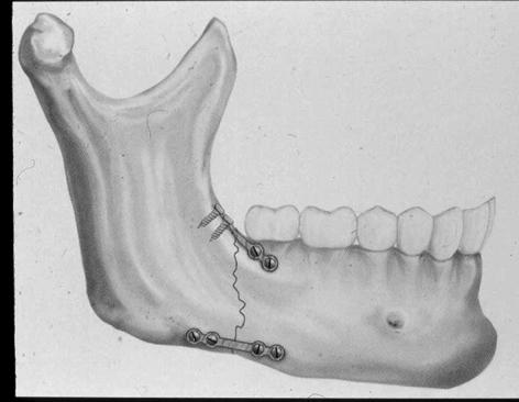 Kasvovammatyypit (401 potilasta) Hanna Thorén, MD, DDS, PhD,* Johanna Snäll, DDS, Jari Salo, MD, PhD, Liisa Suominen-Taipale, DDS, PhD, MSc,