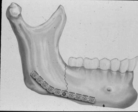 SurgeonsJ Oral Maxillofac Surg 68:805-810, 2010 Murtumatyypit: Exclusively mandibular 134 33.4% Exclusively zygomatico-orbital 127 31.