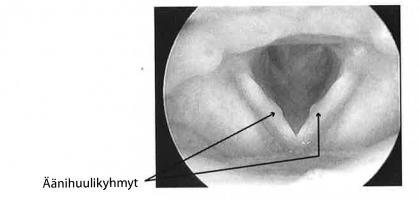 Äänihäiriön syitä tulehdukset kyhmyt ja polyypit