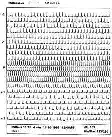 A B Kuva 1. Esimerkki yhdestä oire-ekg-tallenteesta (A) ja siitä tulostetusta suurennoksesta (B). Potilas on 33-vuotias mies, jolla oli sulkapalloa pelatessa alkanut tykytystuntemus.