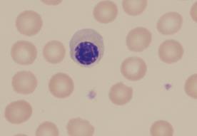 11 (59) KUVA 2. Erytroblasteja (Keinänen ja Pakarinen 2017). Yksittäisten punasolujen kokomuutoksia ei havainnoida, vaan huomio tulee kiinnittää punasolujen kokonaiskuvaan.