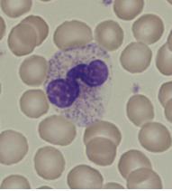 ) Basofiili Basofiilin (kuva 12) suuri ja karkea tummanvioletti granula peittää koko solua.