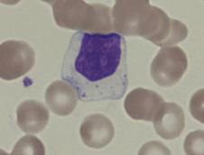 23 (59) Suurilla lymfosyyteillä eli LGL-soluilla (11 15 µm) on paljon sytoplasmaa, joka voi olla epäsäännöllisen muotoista ja väriltään haalean sinertävää (kuva 20).