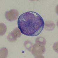 27 (59) Akuutissa myelooisessa leukemiassa soluissa voi esiintyä useita morfologisia muutoksia riippuen leukemian alalajista.