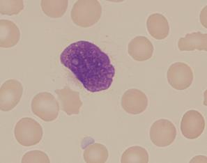 28 (59) sevaa leukosytoosia: kypsien solujen lisäksi tavataan epäkypsiä granulosyyttisarjan soluja sekä blasteja. Basofilia on tyypillistä ja myös eosinofiliaa voi esiintyä.