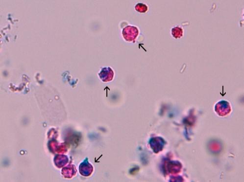 4.3.1 Solut Virtsanäyte voi sisältää puna- ja valkosoluja sekä erilaisia epiteelisoluja. Normaali virtsa voi sisältää muutamia punasoluja. Punasoluja voi tulla näytteeseen myös näytteenotosta johtuen.