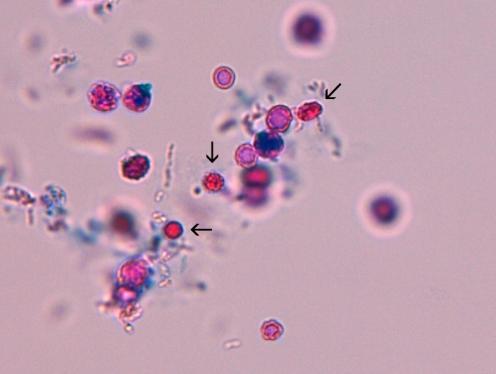 ) Jos virtsanäytteestä löytyy punasoluja, puhutaan hematuriasta eli verivirtsaisuudesta. Punasolut ovat kooltaan 6 8 μm, ja ne ovat tumattomia (kuva 1).