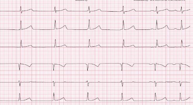 4 Schwartz P, Garson AJ, Paul T ym. Guidelines for the interpretation of the neonatal electrocardiogram. Eur Heart J 2002;23:1329 44. 5 Davignon A, Rautaharju P, Boisselle E ym.