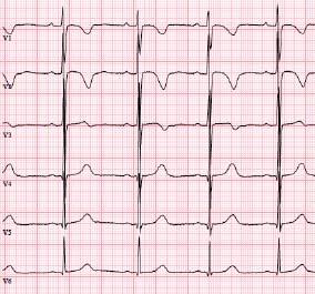 Yleässä EKG:ssä nähdään myös normaalit lapsuusiän rintakytkentöjen T-aallot (negatiivinen kytkennässä V 1 ja positiiviset kytkennöissä V 5 ). B.