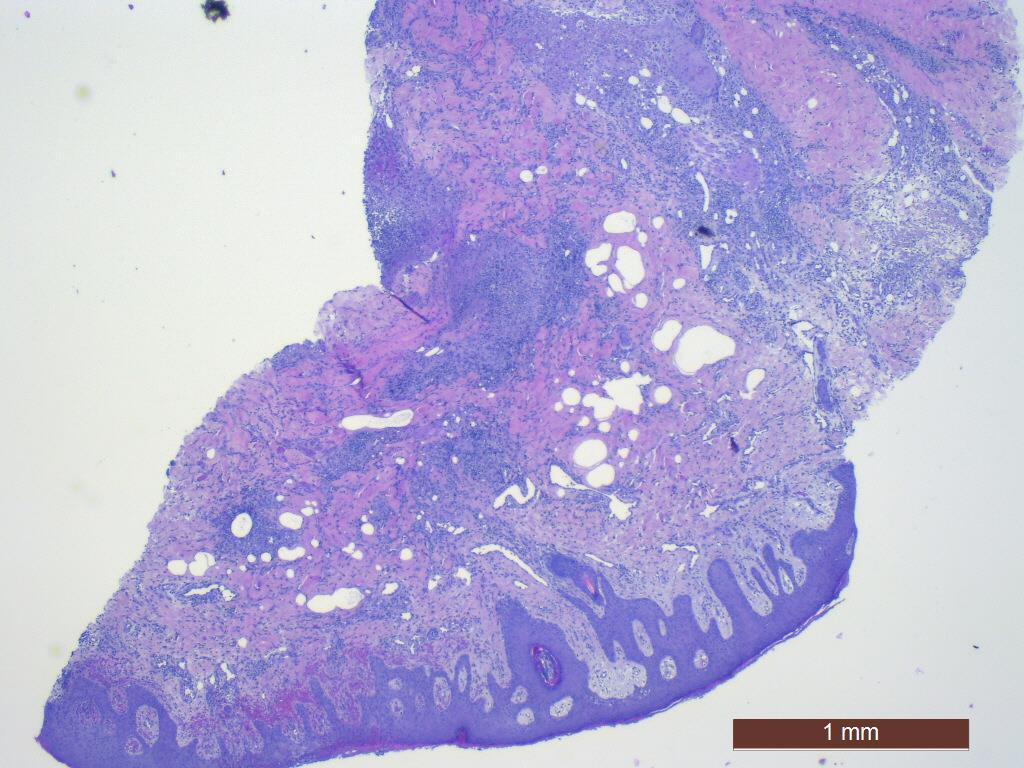 PYODERMA