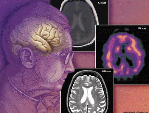 Kaatumiset ja muistisairaudet KAATUMISVAARA Alzheimer 1.95 [1.01-3.78] Vaskulaari dementia 1.77 [1.17-2.