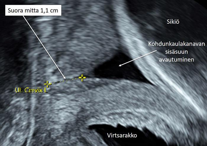 Käypä hoito -suositus 5 (27) [kuva 1]=Kohdunkaulakanavan pituuden mittaaminen, kun sisäsuu on auennut Maija-Riitta Ordén 31.5.2017 Kohdunkaulakanavan pituus mitataan sisäsuulta ulkosuulle.