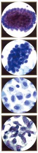 Endometrium Endometriaaliset solut voivat muodostaa kolmiulotteisia palloja ilman stroomaa. Tumat pieniä, pyknoottisia, degeneroituneita.