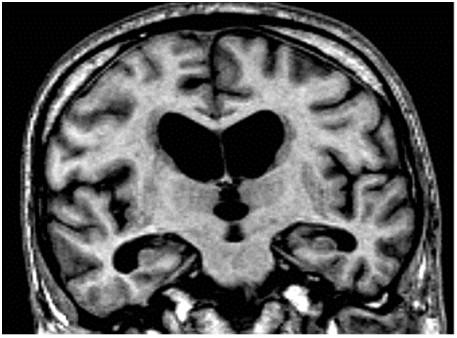 MRI brain volumes Hippocampal volume - left and right Left 0.