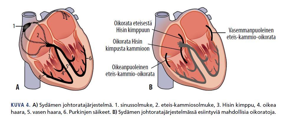 KAMMIOTAKYKARDIA HARVINAINEN SIKIÖIDEN TAKYKARDIOISTA 1-2 % ETEISET SUPISTUVAT KAMMIOITA HITAAMMIN; KAMMIOTAAJUUS 180-300/MIN AKUUTTI