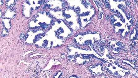 1. Johdanto 2 ja tiehyeparenkyymista että sidekudoksen ja sileän lihaskudoksen muodostamasta bromuskulaarisesta stroomasta. [5] Fibromuskulaarinen strooma on supistumiskykyinen.