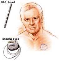 stimulation (DBS)