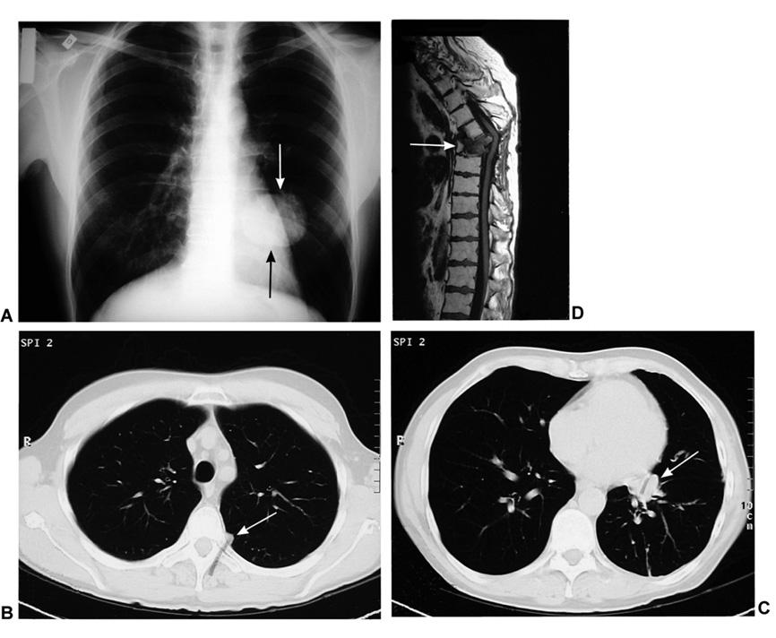 Kuva 1. Potilaan 1 keuhkokuvassa (A) näkyi suuri kasvainvarjo vasemmassa keuhkossa (nuolet).